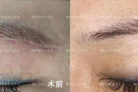 眉毛上的刀疤与命运的微妙联系探讨