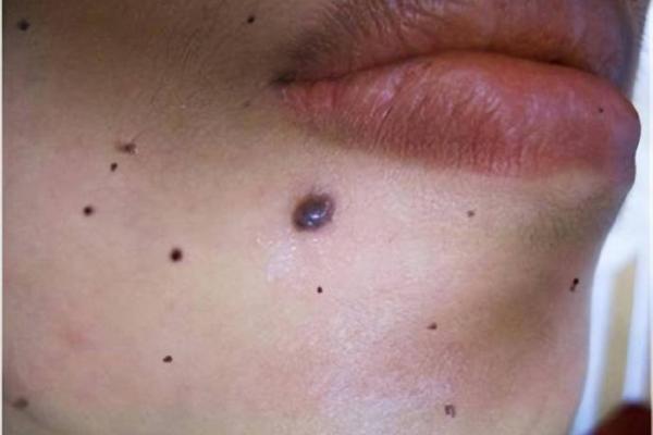 眉心有痣:解读童子命的神秘寓意与人生影响 眉心有痣:解读童子命的神秘寓意与人生影响