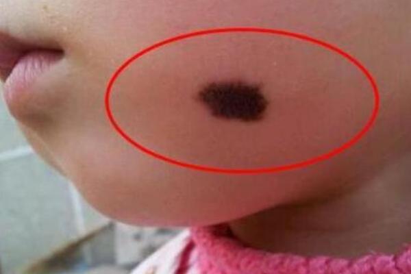 胎记与命运:揭秘女人胎记背后的真实寓意与人生轨迹 胎记与命运:揭秘女人胎记背后的真实寓意与人生轨迹