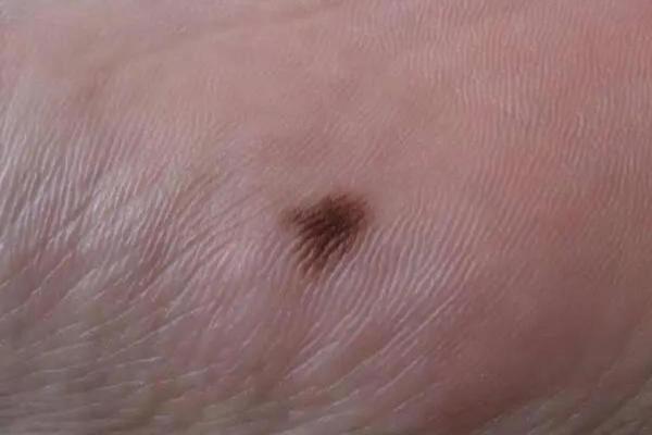 男人右脚脚底一颗痣的命运解析:暗示财富与健康的象征! 男人右脚脚底一颗痣的命运解析:暗示财富与健康的象征!