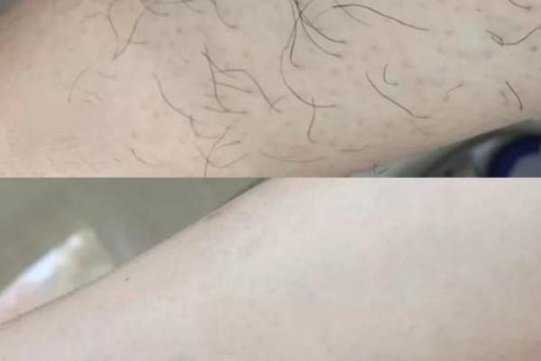 没有腿毛的男生,究竟是什么命运? 没有腿毛的男生,究竟是什么命运?